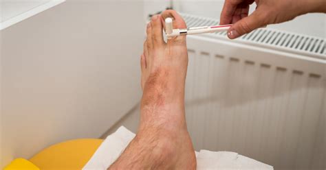 Tratamentul ulcerelor piciorului în diabet cu remedii populare